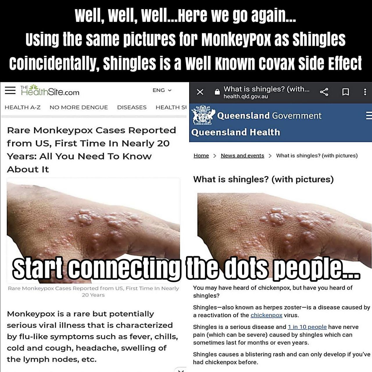 Monkeypox aka Shingles Is A Vaccine Adverse Reaction