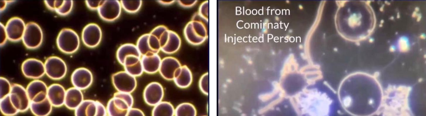 Normal Blood vs Vaccinated